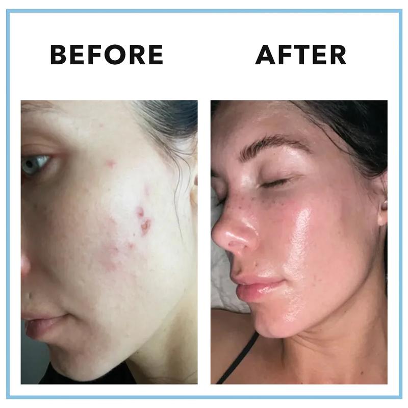 MINDBODYSKIN® Hormonal Acne Supplement